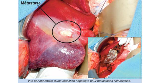 Chirurgie du Foie