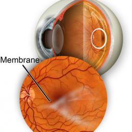 Membrane épi-maculaire