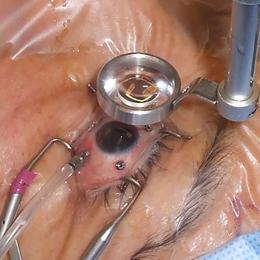Opération vitrectomie mini-invasive au bloc opératoire