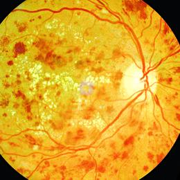 Fond d'oeil de Rétinopathie diabétique