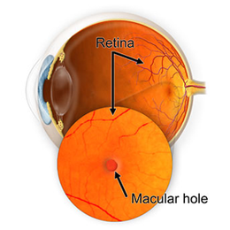 Trou maculaire au fond d'oeil