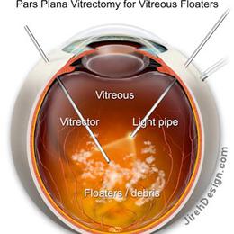 Principe de vitrectomie 