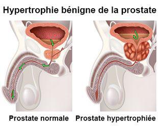 hypertrophie prostate traitement laser