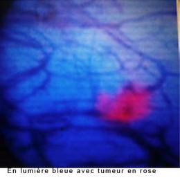 lumionofluorescence_tumeur_vessie_hopital_libourne.jpg