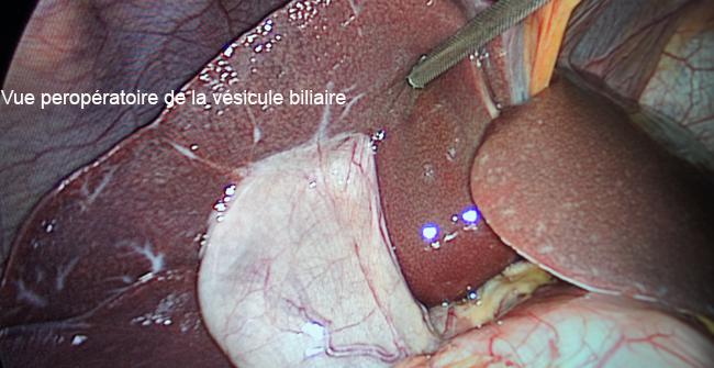 Cholécystectomie - Centre Hospitalier Libourne